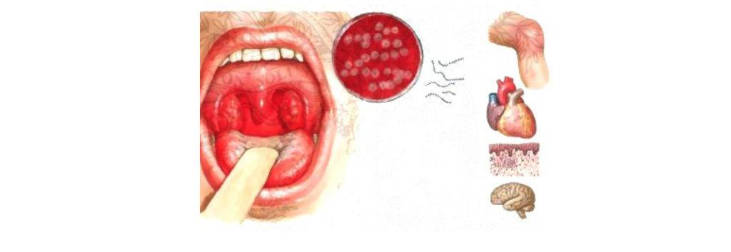 Стафиллокок в носу: лечение. причины инфекции. что это такое?