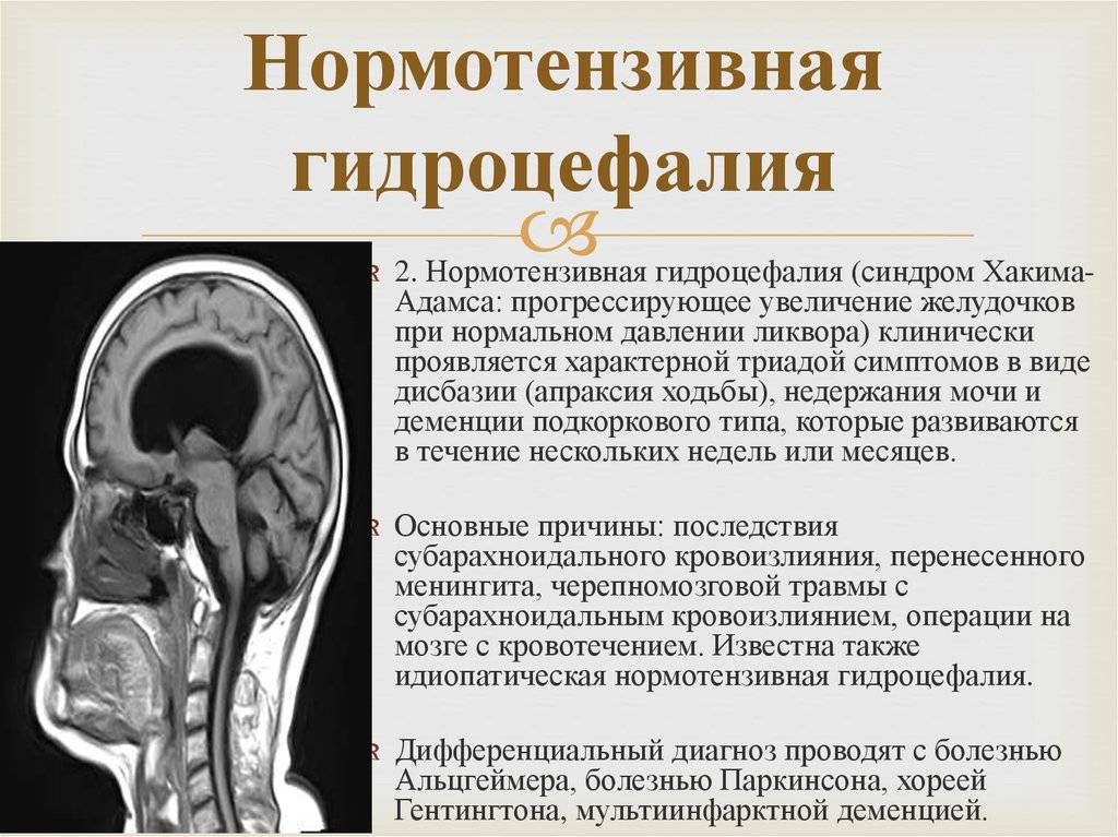 Неокклюзионная гидроцефалия. Синдром Хакима-Адамса нормотензивная гидроцефалия. Нормотензивная гидроцефалия мрт. Наружная гидроцефалия головного мозга. Нормотензивная гидроцефалия кт.