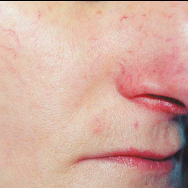 Эффективные методики лечения купероза на лице или как избавиться от венозной сеточки?