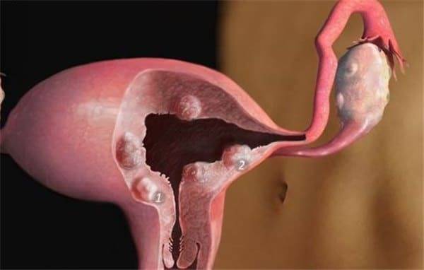 Выскабливание полипа в матке: отзывы женщин о возможных последствиях после проведения процедуры и возможен ли рецидив