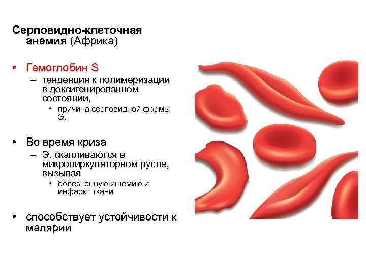 Серповидноклеточная анемия. серповидноклеточная анемия: развитие, симптомы, лечение, прогноз болезнь серповидноклеточная анемия - заболевания-мед