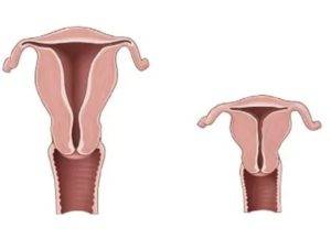 Гипоплазия матки: 1 и 2 степени, симптомы, признаки, лечение – можно ли забеременеть с маточной гипоплазией — медицинский женский центр в москве