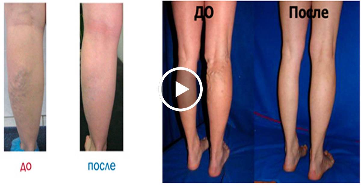 Различные способы лечения варикоза вен на ногах