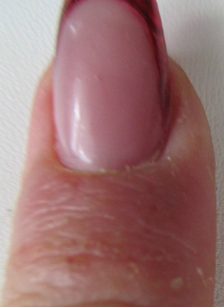 Покраснение между пальцами рук: фото, причины и лечение зуда и шелушения кожи