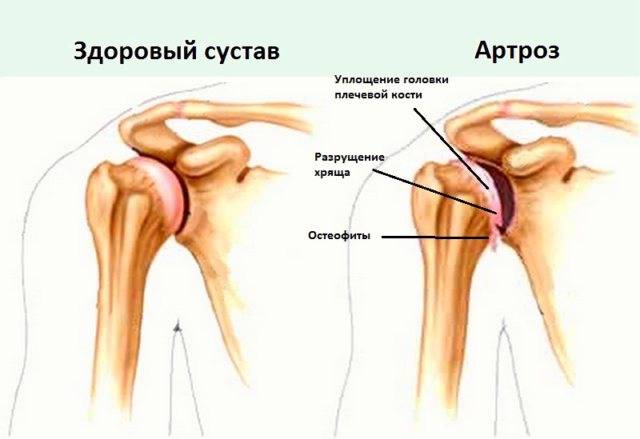 Лечение остеоартроза плечевого сустава
