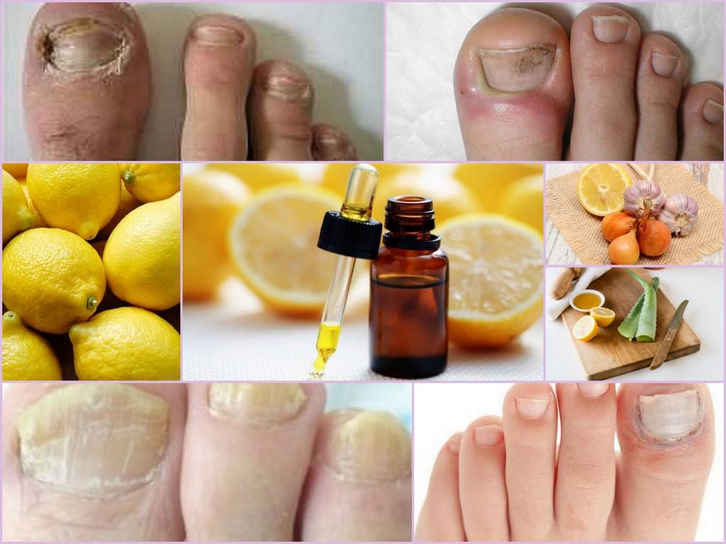 Самые эффективные народные средства лечения грибка ногтей на ногах