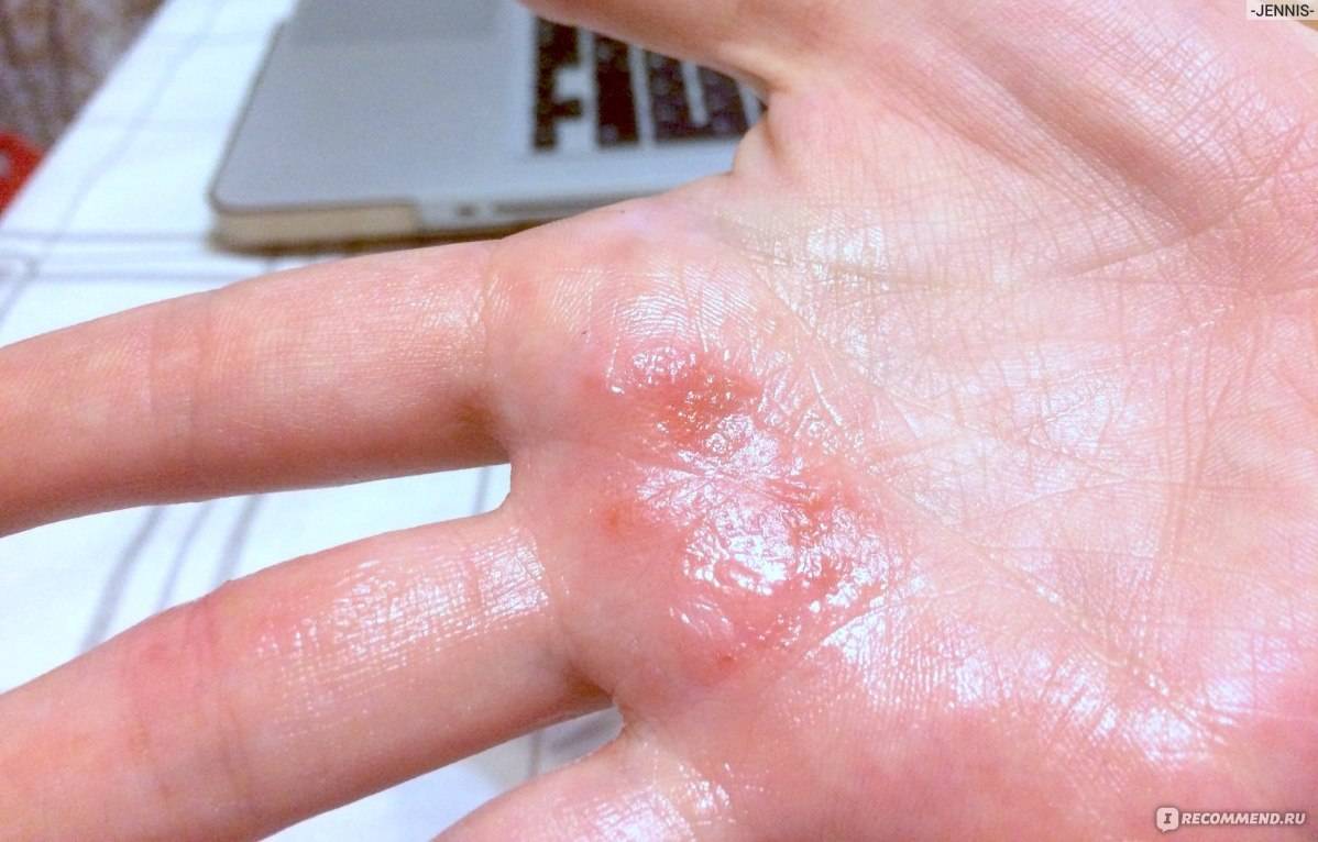 Лечение экземы на руках мази — аллергия