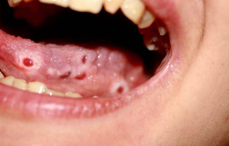 Герпесный стоматит у детей сколько дней заразен - стоматология