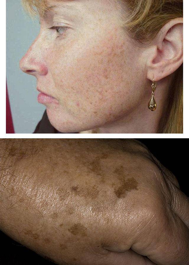 Себорейная кератома по мкб 10. кератома кожи — симптомы и лечение у взрослых, фото на лице, голове