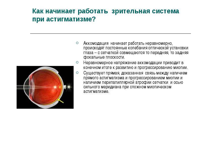 Миопический астигматизм простой и сложный - что это такое и как лечить нарушение зрения разной степени очками и контактными линзами