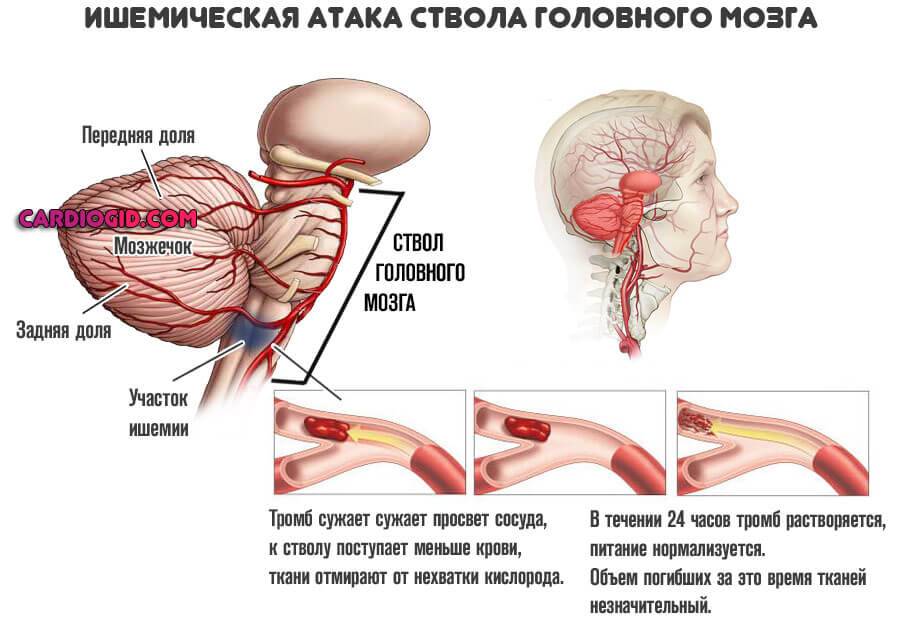 Стволовой инсульт прогноз. Ишемического инсульта ствола мозга симптомы. Транзиторная ишемическая атака головного мозга симптомы. Инсульт ствола головного мозга. Ишемический инсульт ствола головного мозга.