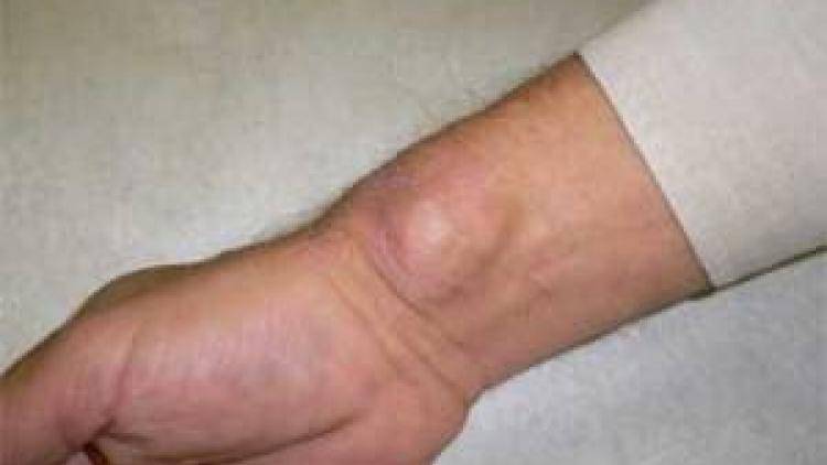 На пальцах рук появились шишки: как выглядят, фото. причины появления шишек на пальцах рук. лечение шишек на пальцах рук: медикаментозные и народные средства — лечение суставов