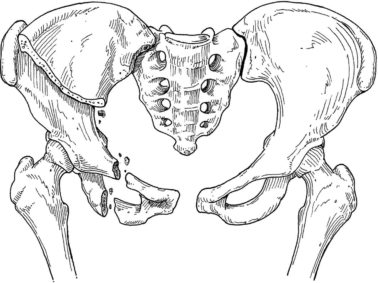 Крестец подвздошная кость. Перелом лонной и седалищной кости таза. Перелом седалишнего кости. Кости таза лонная кость.