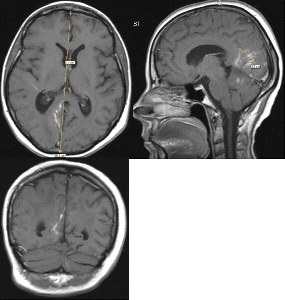 Метастазы в головном мозге: симптомы, продолжительность жизни и лечение