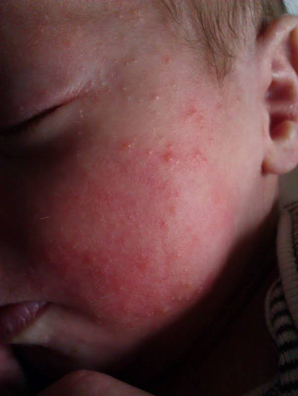Аллергия на глютен у ребёнка и взрослого: симптомы, как проявляется, фото и лечение аллергической реакции организма