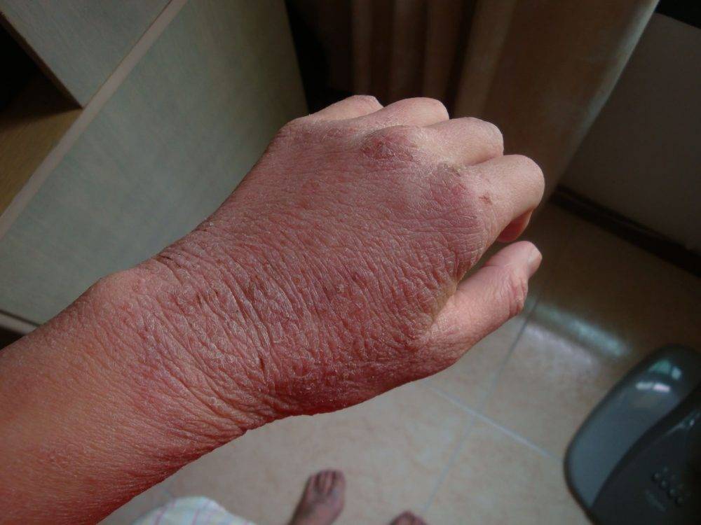 Дисгидротическая экзема кистей рук: причины возникновения, симптоматика, клиническая картина, мази, ванночки и народные средства для лечения