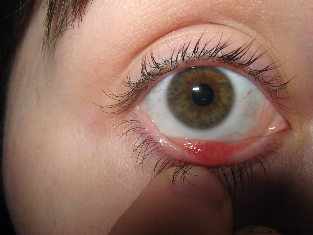 Все о ячмене на глазу у ребенка: первые симптомы и лечение
