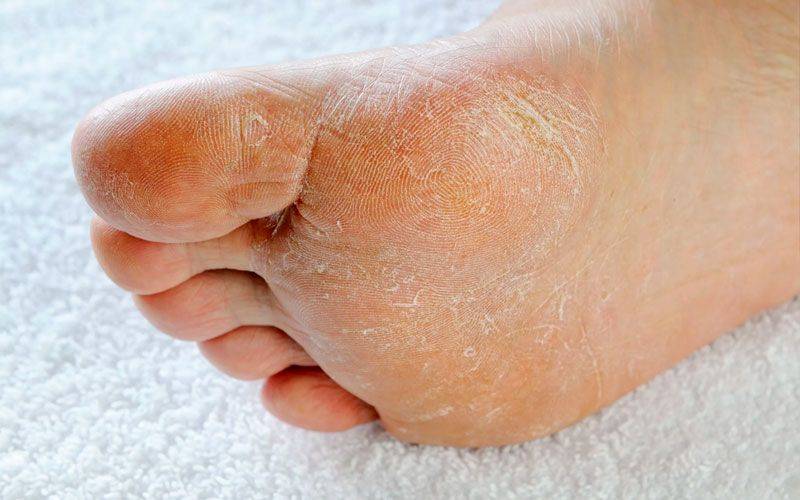 Причины сухой кожи на ногах и методы лечения