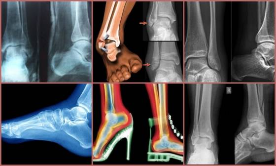 Рентген коленного сустава: что показывает снимок в двух проекциях, как делают