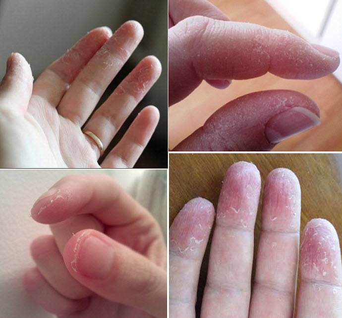 У ребенка на пальцах облазит кожа - почему шелушится кожа и что делать? • твоя семья - информационный семейный портал