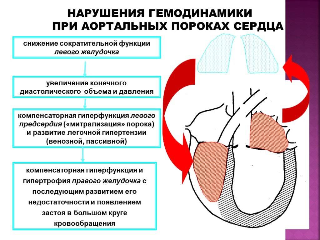 Концентрическая гипертрофия левого желудочка сердца