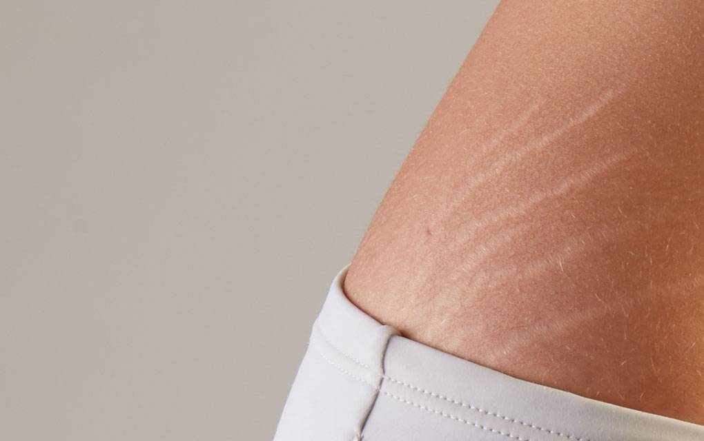 Почему у мужчин появляются растяжки кожи и как их лечить