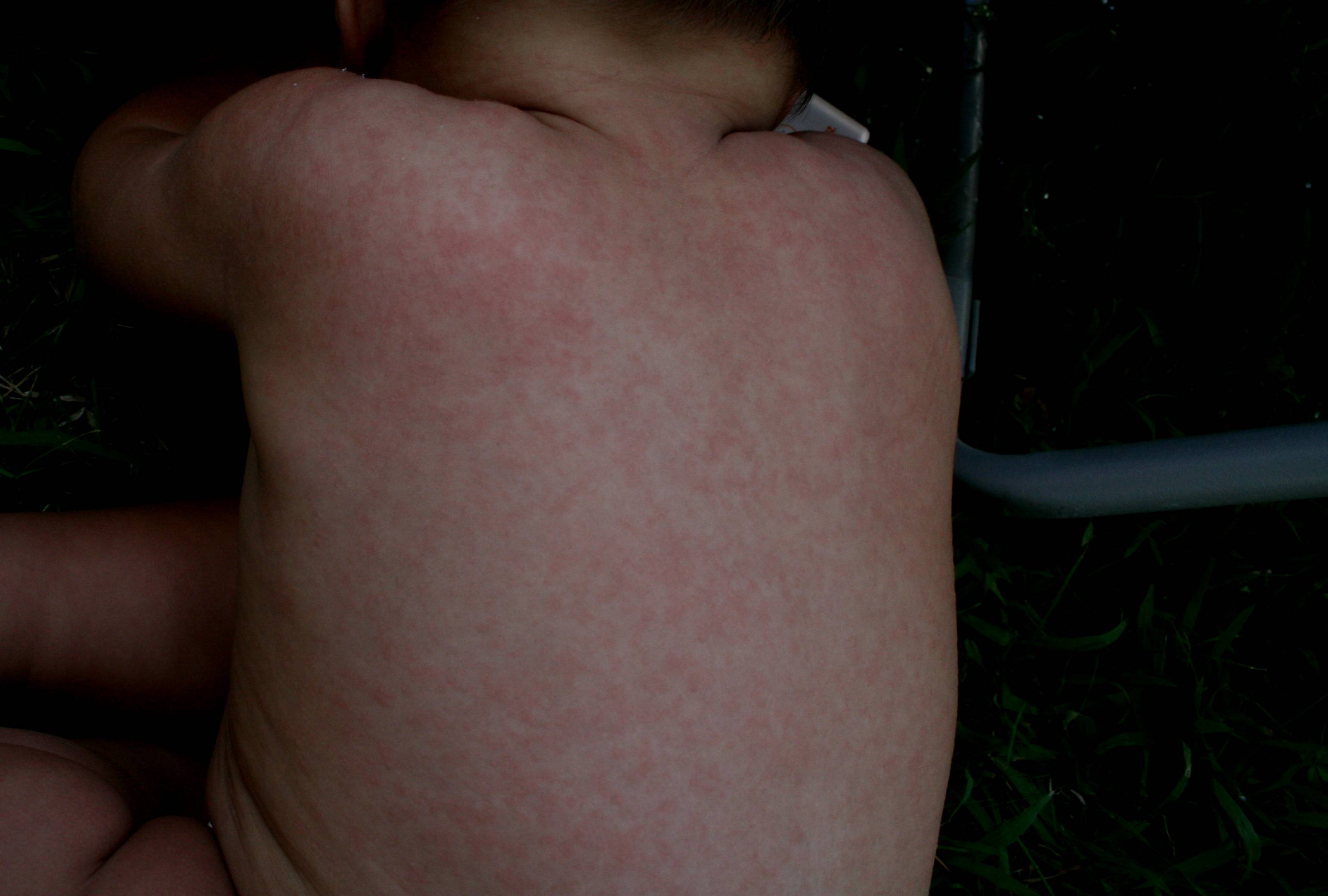 Аллергия у детей, фото различной сыпи: причины, виды и лечение