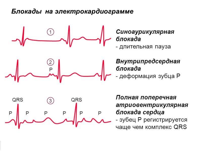 Нарушение внутрижелудочковой проводимости сердца: что это такое?