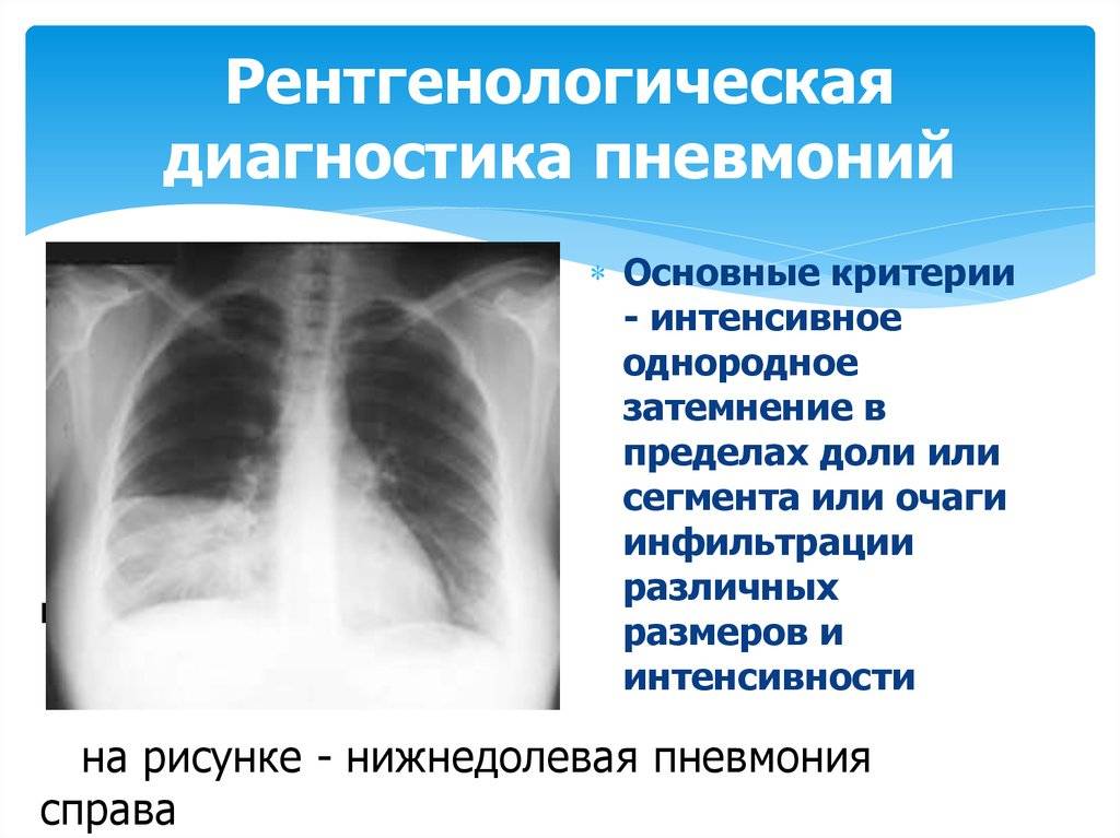 Изменения на рентгенограмме при пневмонии