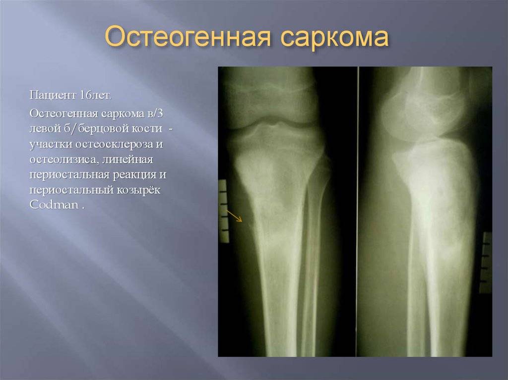 Чем отличается саркома. Остеогенная остеолитическая саркома. Саркома Юинга большеберцовой кости рентген. Остеосаркома левой большеберцовой кости. Остеогенная саркома бедренной кости рентген.