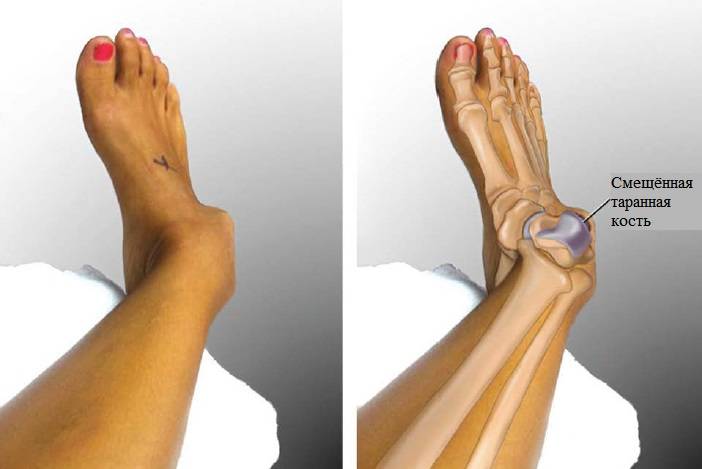 Сколько ходят с гипсом при переломе пальца ноги