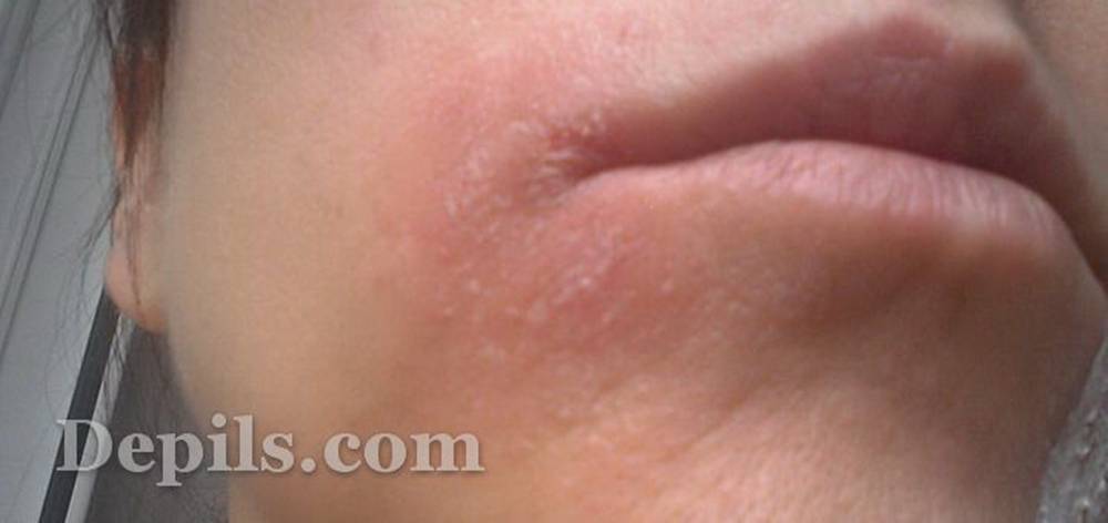 Чем может быть вызвано шелушение и покраснение кожи вокруг рта