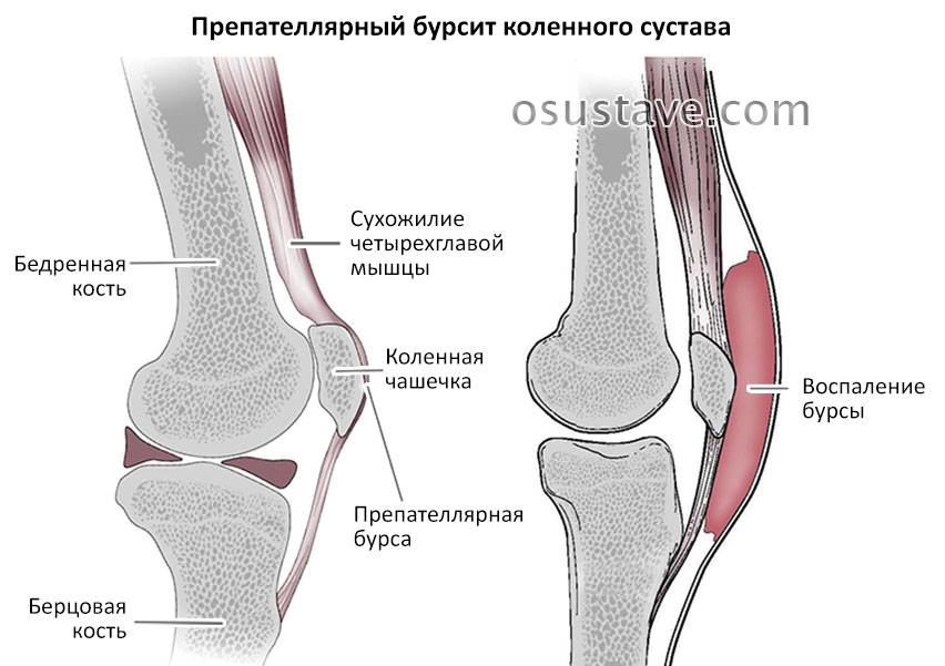 Инфрапателлярный бурсит коленного сустава: симптомы и лечение подколенного бурсита