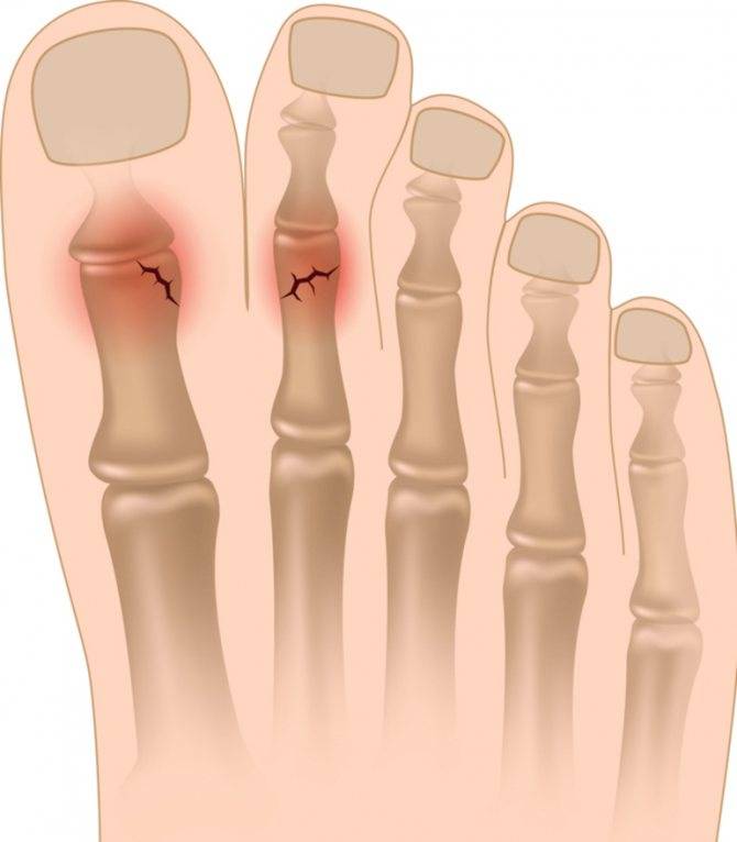 Краевой перелом большого пальца ноги