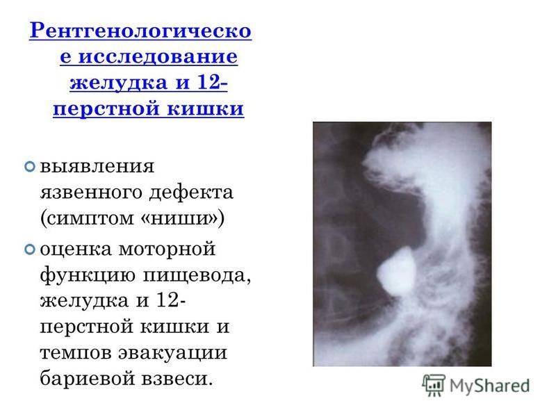 На узи виден желудок. Опухоль 12 перстной кишки на рентгене. Рентгенологические методы исследования желудка и 12 перстной кишки. Рентген исследования желудка и 12 перстной кишки. Опухоль двенадцатиперстной кишки рентген.