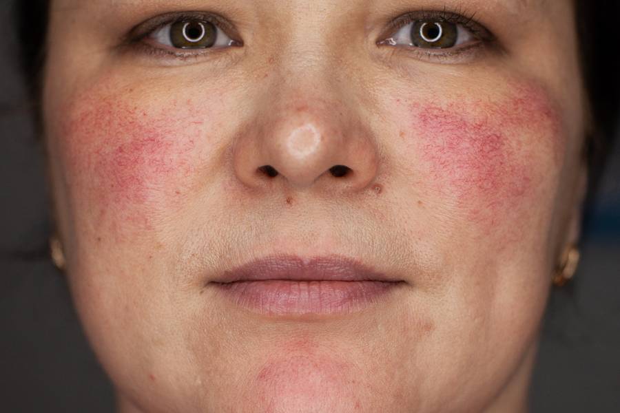 Красные пятна на лице: устранение причин, медикаментозное лечение, народные средства