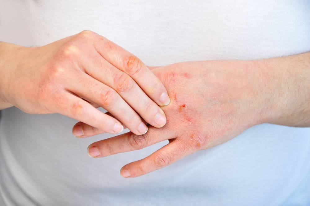 ✸ что такое дерматит ✸ лечение ✸ мази и кремы