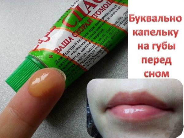 Лечение заедов в уголках губ: лекарства, мази и кремы, витамины и народные средства