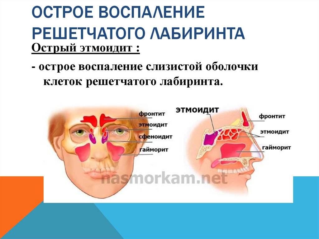 Хронический сфеноидит. Что такое этмоидит в носовой пазухе ?. Хронический гайморит этмоидит фронтит. Синусит решетчатой пазухи симптомы. Хронический Гнойный этмоидит.
