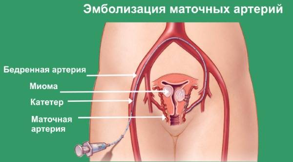 Эмболизация маточных артерий при миоме матки (эма): отзывы пациентов и противопоказания к проведению процедуры
