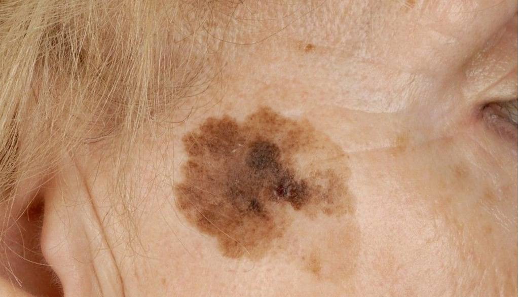 Возрастные пигментные пятна на лице и коже: причины и лечение