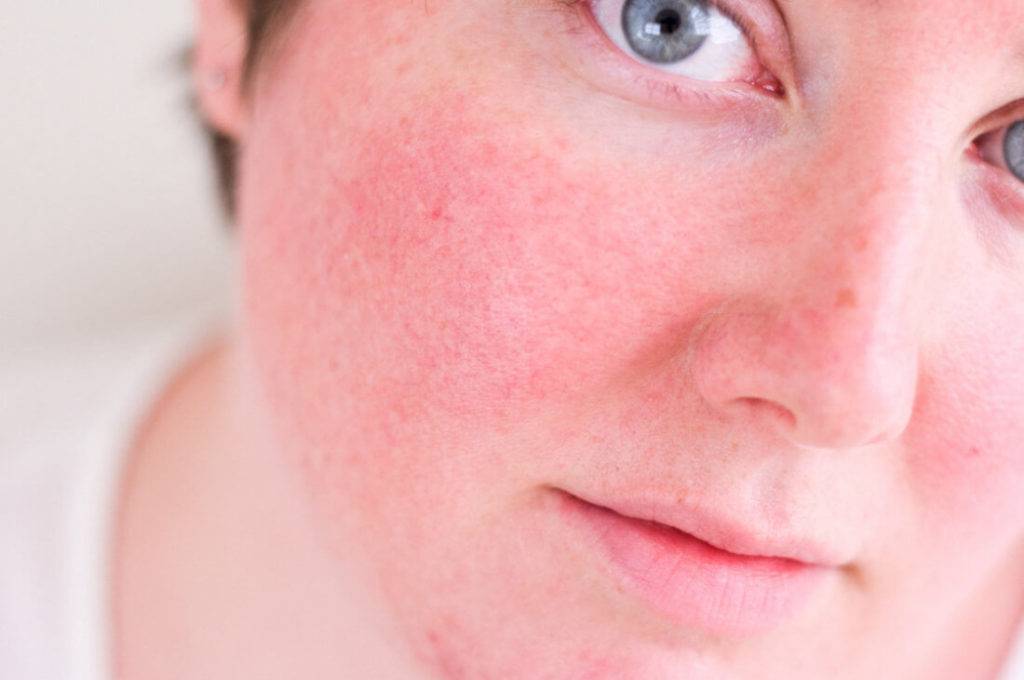 Купероз на лице: лечение и отзывы