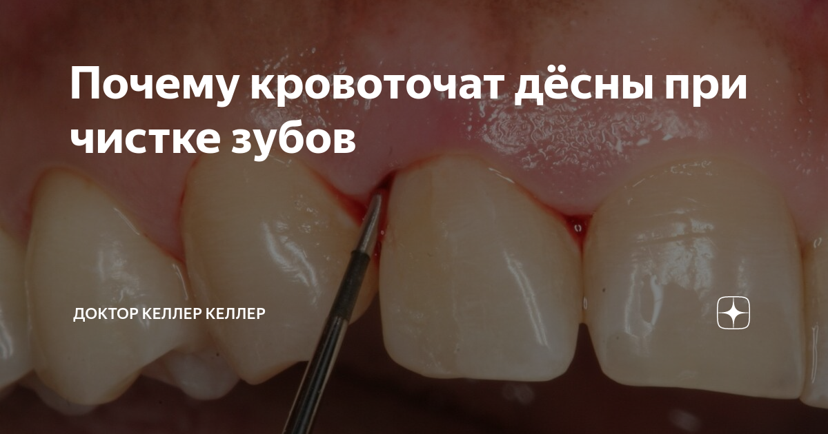 Почему болят десны, когда вы чистите зубы