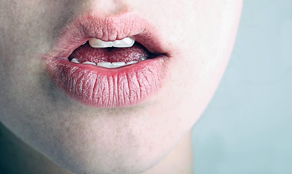 Почему трескаются губы - причины, что делать, как лечить