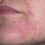 Что делать если шелушится кожа вокруг рта и губ