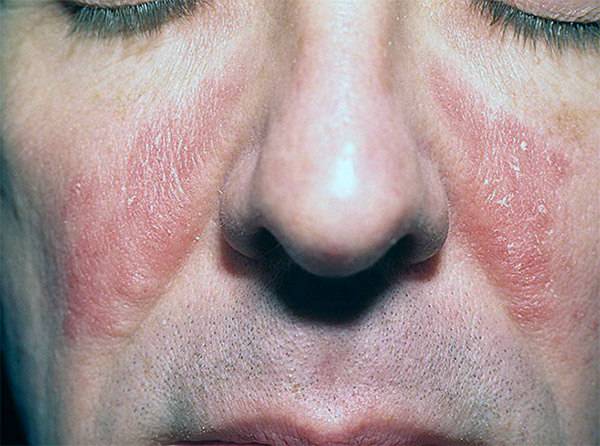 Покраснение и шелушение кожи на лице: причины и лечение