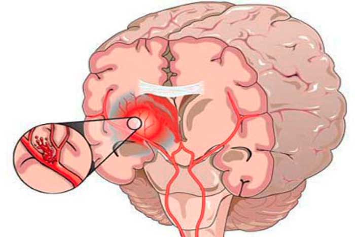 Как проявляется энцефалопатия головного мозга у пожилых