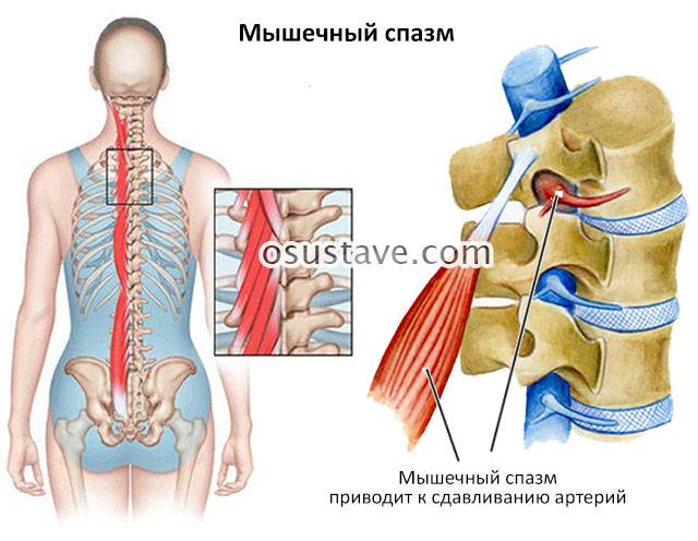 Спазм мышц шеи и плеч (воротниковой зоны): симптомы, причины, лечение