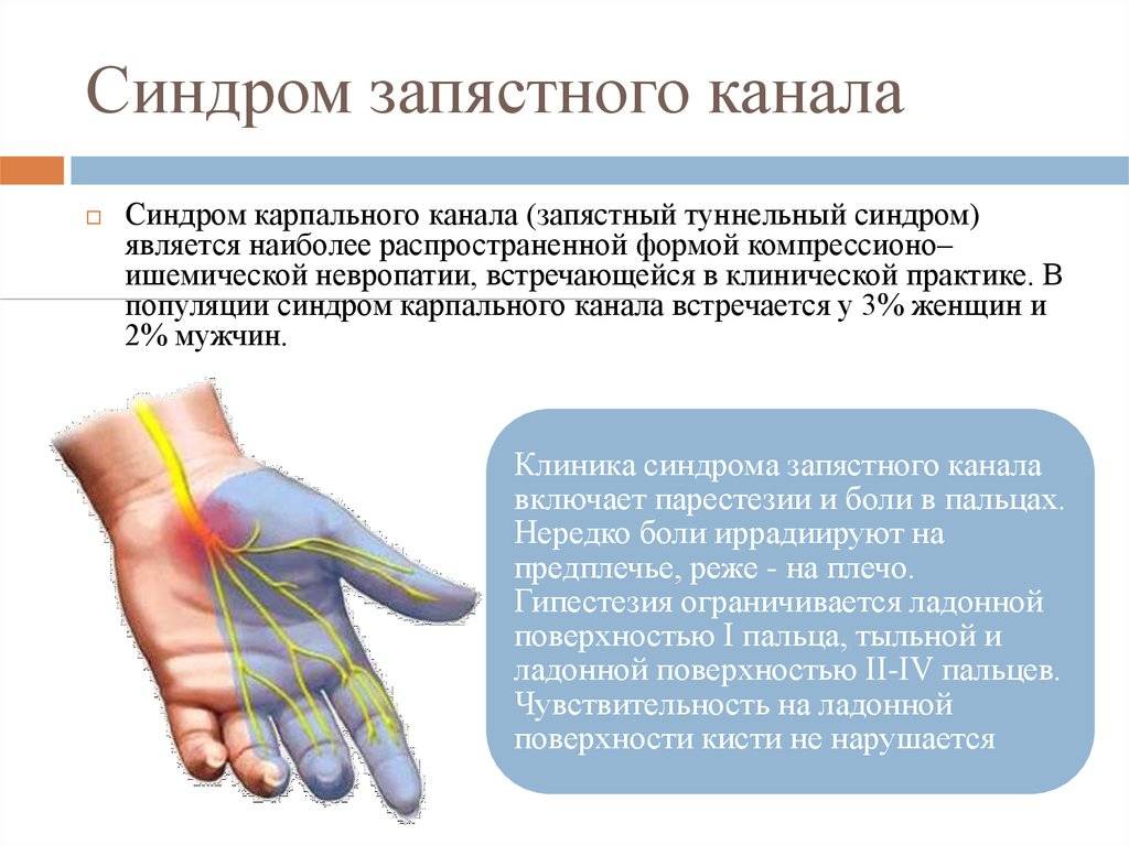 Туннельный синдром запястья кисти руки: симптомы, причины развития, лечение, профилактика