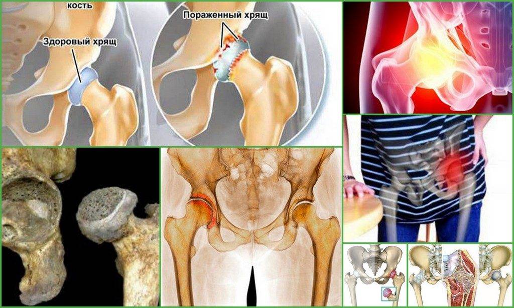 Причины, симптомы и диагностика артрита тазобедренного сустава. лечение артрита тазобедренного сустава у взрослых. гимнастика при артрите тазобедренного сустава — лечение суставов